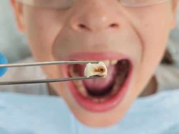 Best Broken or Cracked Tooth Emergency Dentist in Gonzales, LA